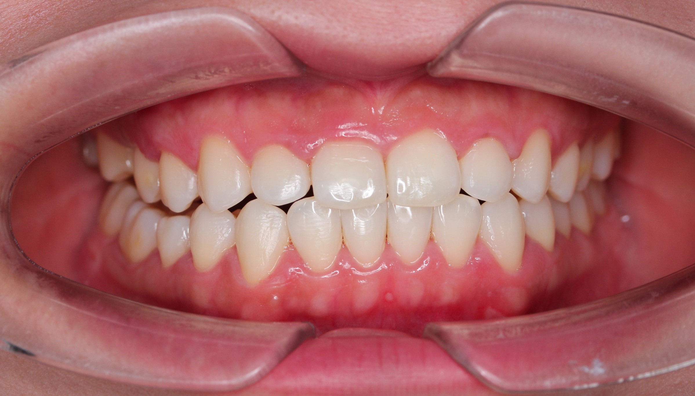 Sau điều trị — Niềng răng trong suốt ClearCorrect – Tái tạo nụ cười hoàn mỹ, không lộ mắc cài