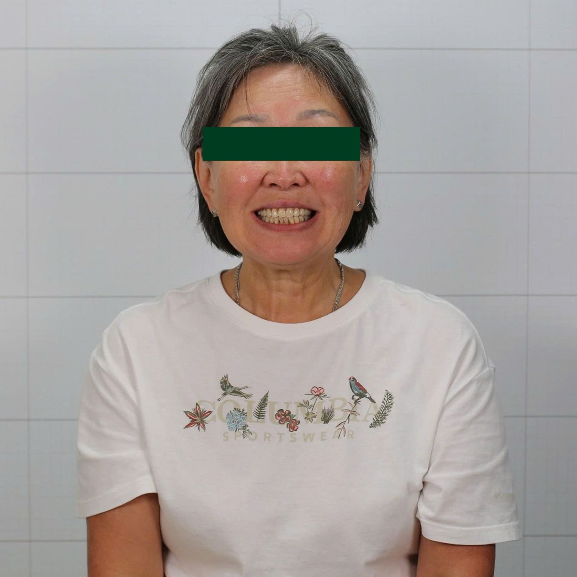 Removable Dentures