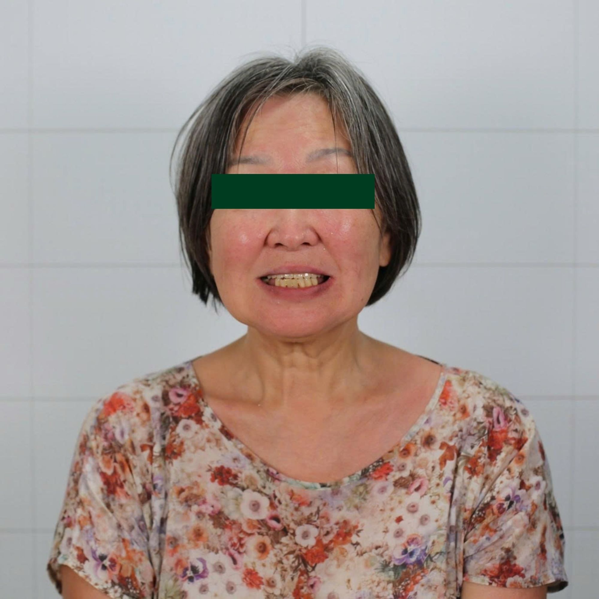 Removable Dentures