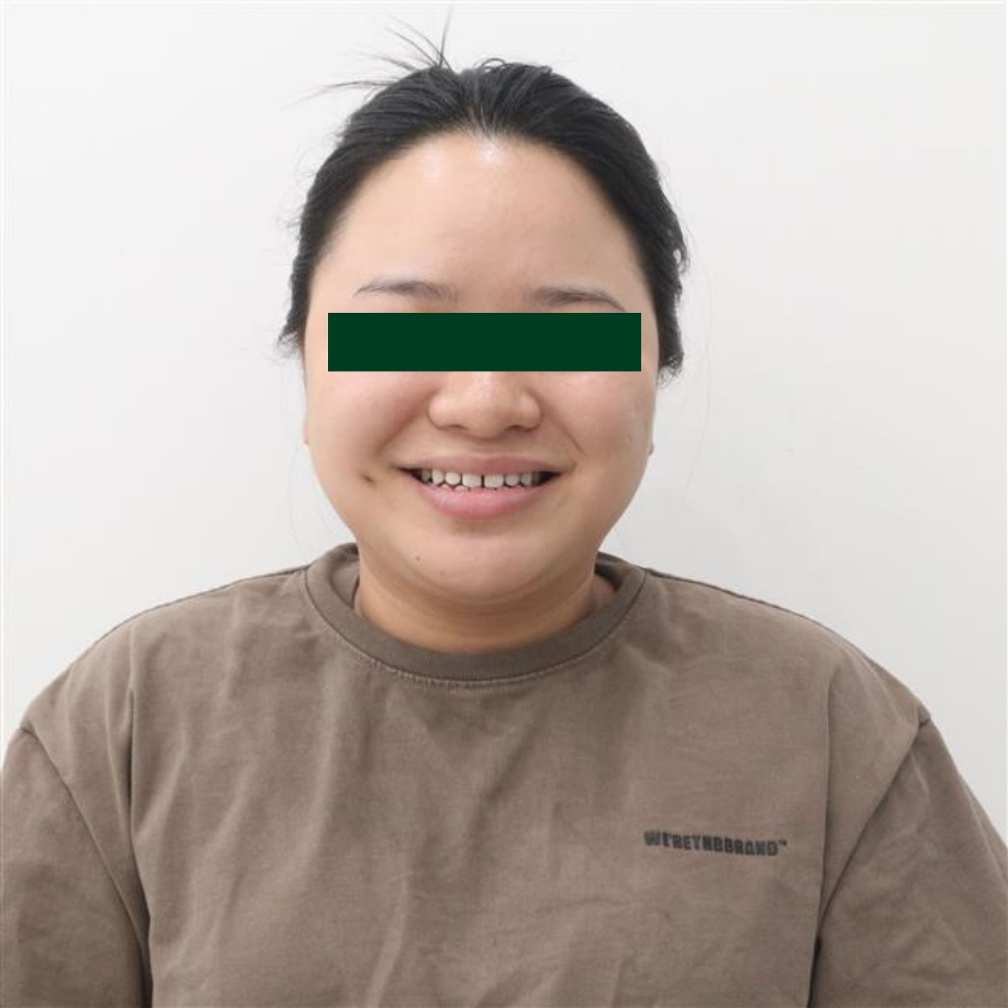 Niềng răng trong suốt ClearCorrect – Tái tạo nụ cười hoàn mỹ, không lộ mắc cài