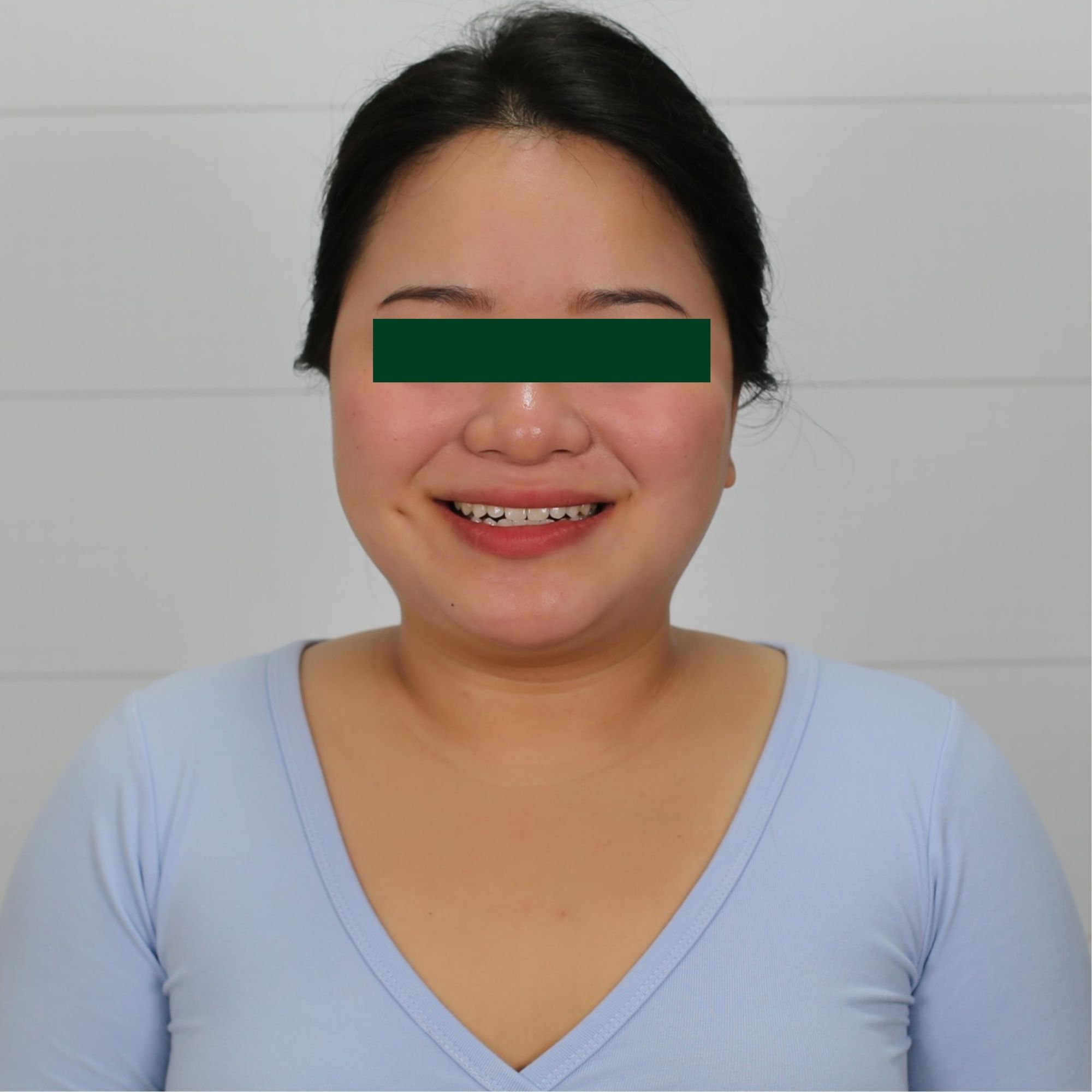 Niềng răng trong suốt ClearCorrect – Tái tạo nụ cười hoàn mỹ, không lộ mắc cài