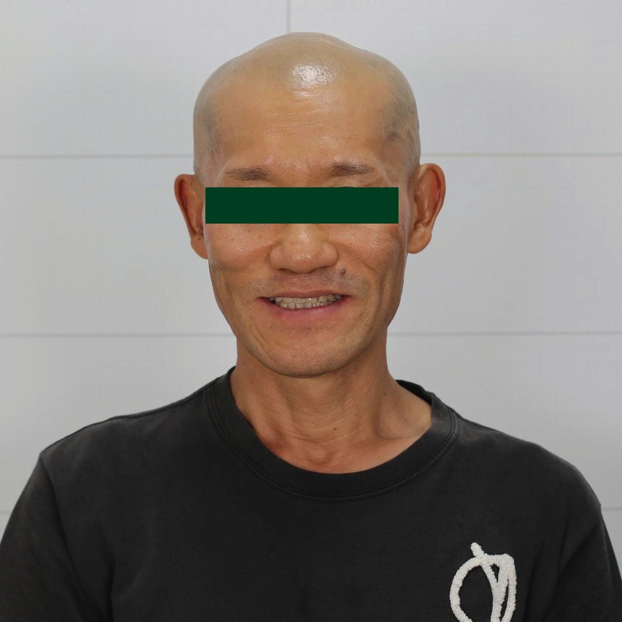 Full Porcelain Crown Smile Makeover