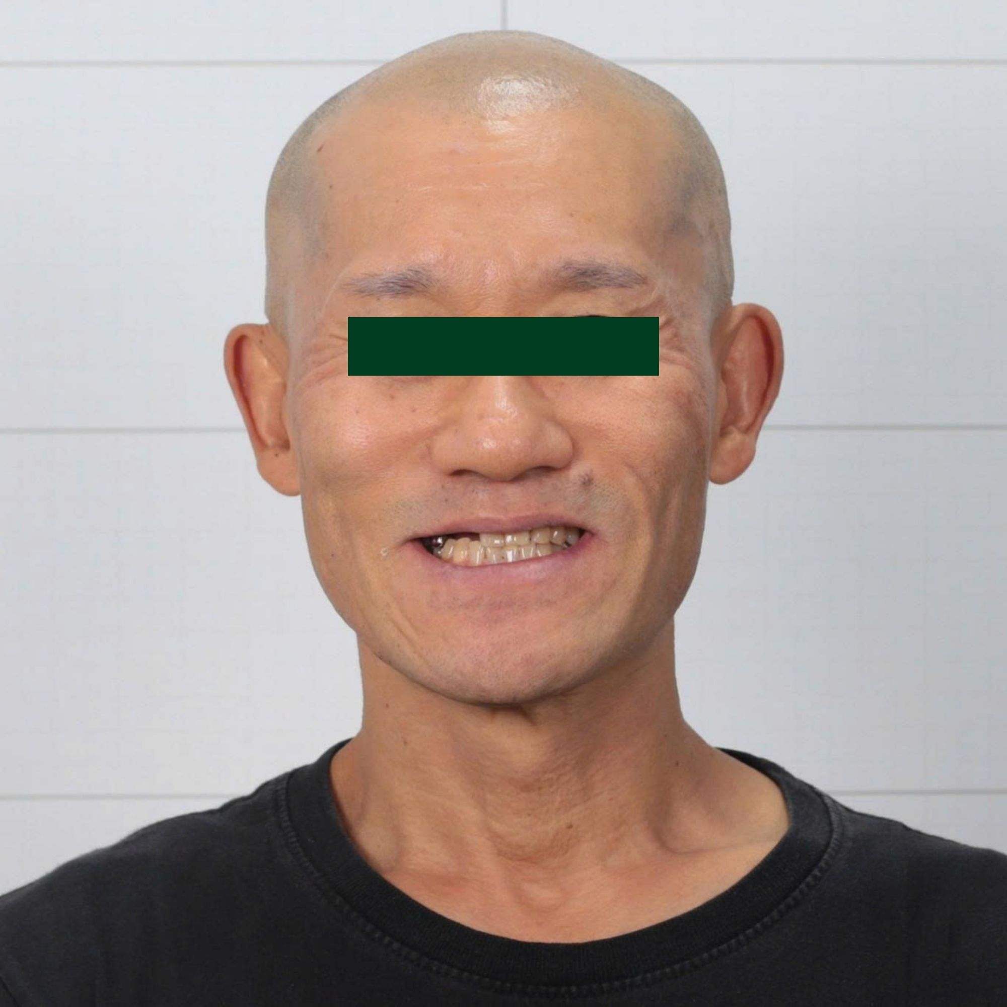 Full Porcelain Crown Smile Makeover