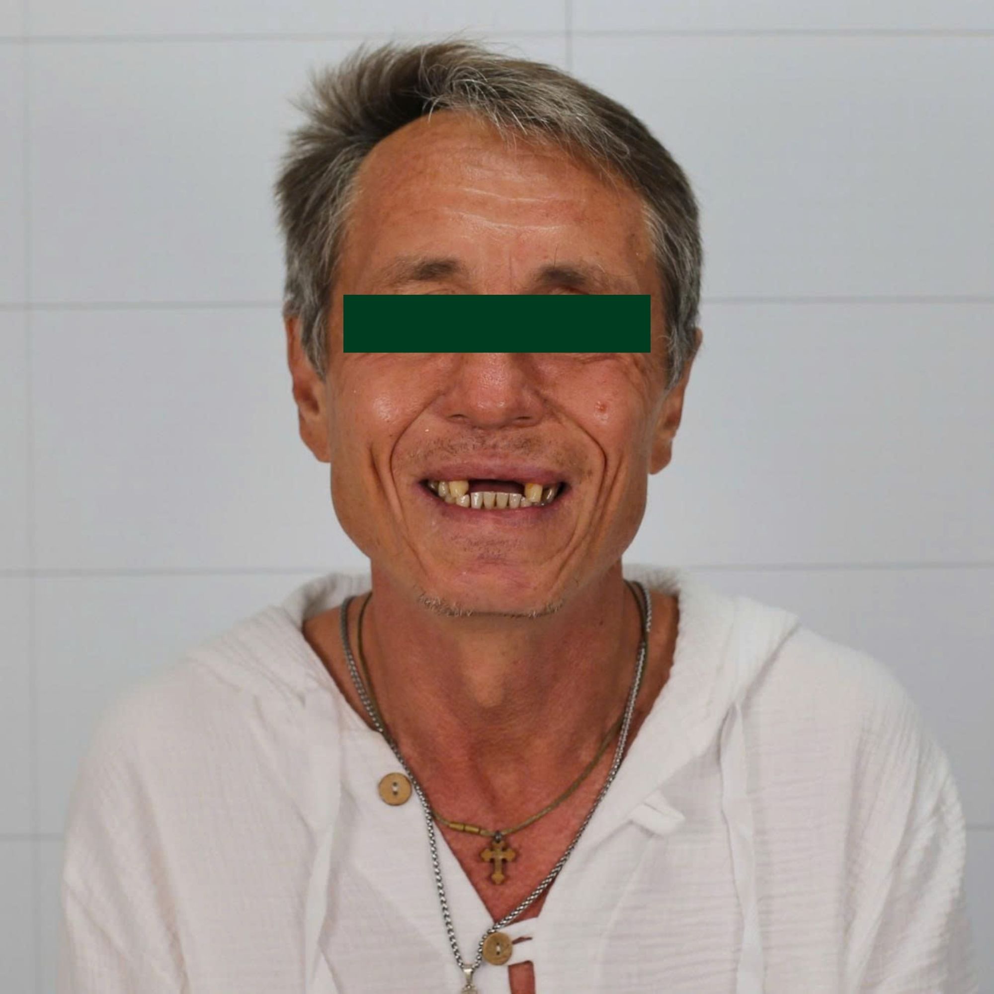 Neodent Implant Placement & Cercon Porcelain Restoration
