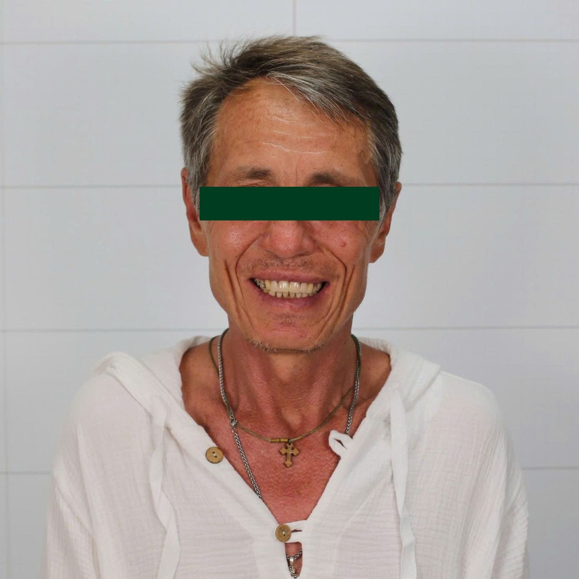 Neodent Implant Placement & Cercon Porcelain Restoration