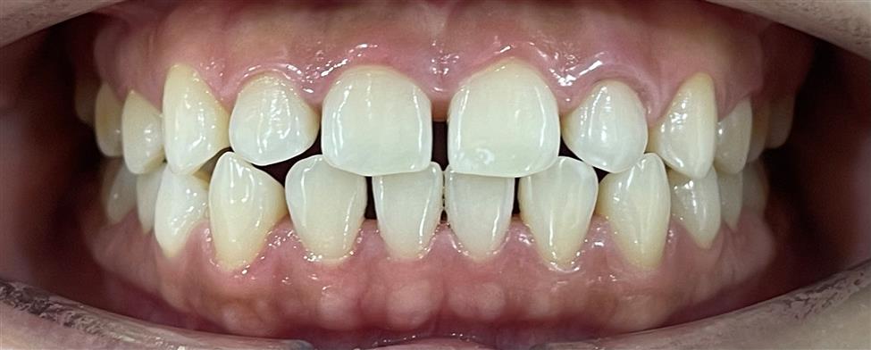 Niềng răng trong suốt ClearCorrect – Tái tạo nụ cười hoàn mỹ, không lộ mắc cài