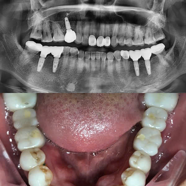 Sau điều trị