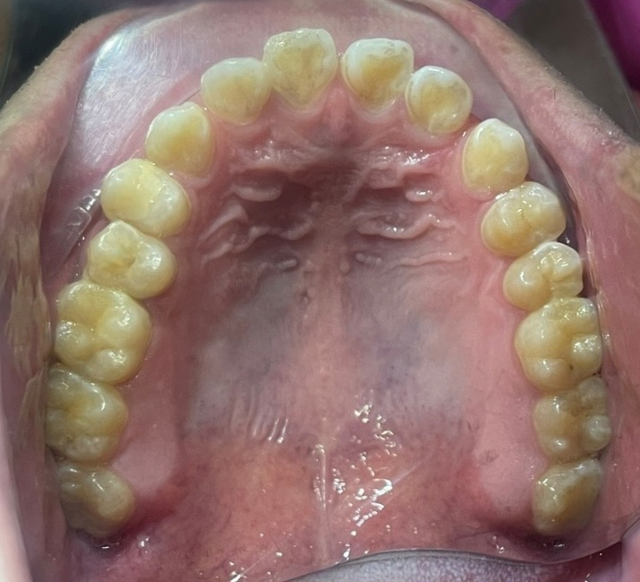 Cấy ghép Implant BioTem và Phục hình Răng sứ Zirconia – Khôi phục răng hàm