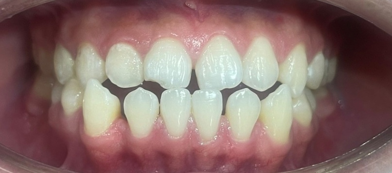 Cấy ghép Implant BioTem và Phục hình Răng sứ Zirconia – Khôi phục răng hàm