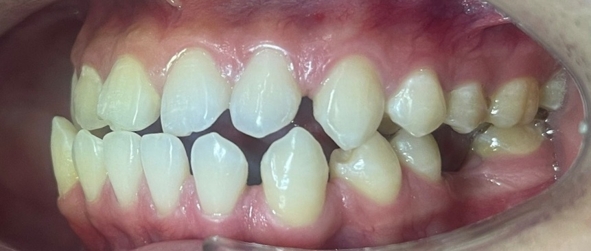 Cấy ghép Implant BioTem và Phục hình Răng sứ Zirconia – Khôi phục răng hàm