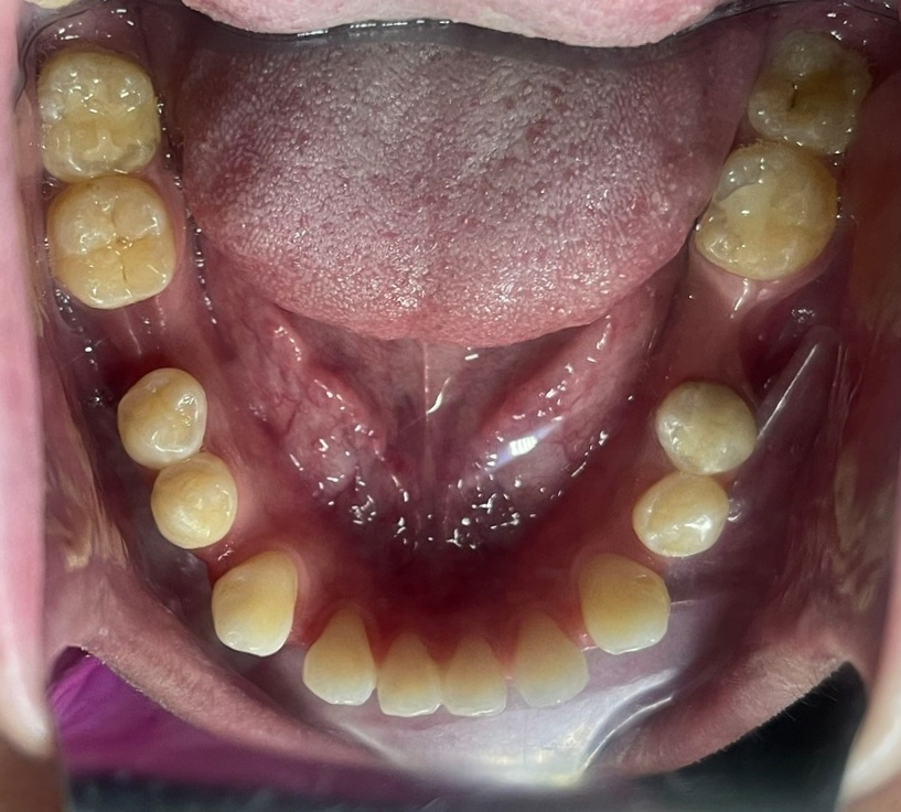 Cấy ghép Implant BioTem và Phục hình Răng sứ Zirconia – Khôi phục răng hàm