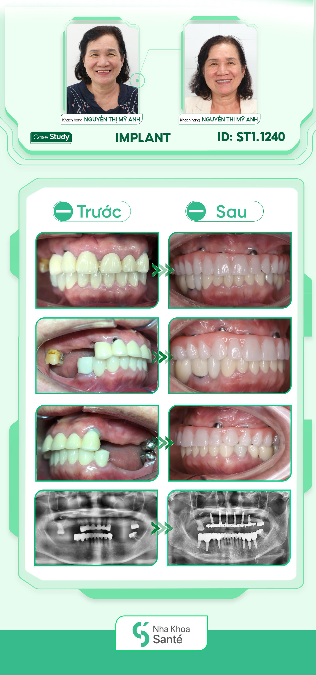 Implant đơn lẻ răng hàm