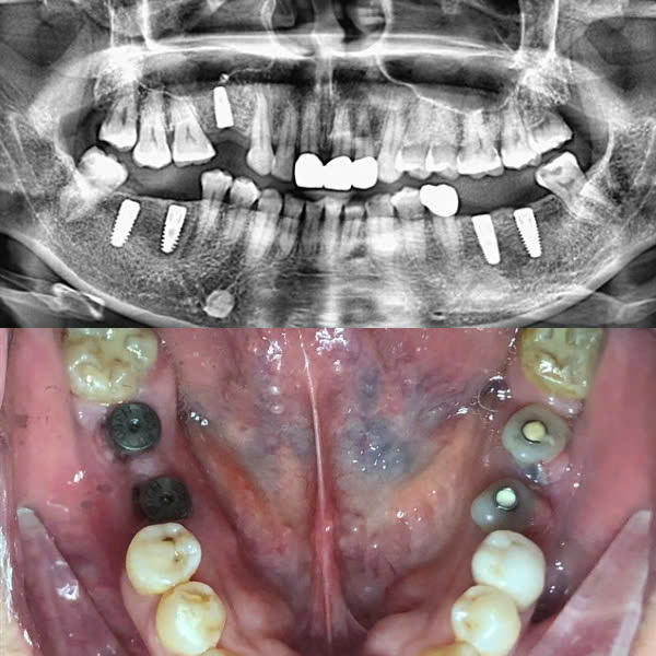 Trước điều trị