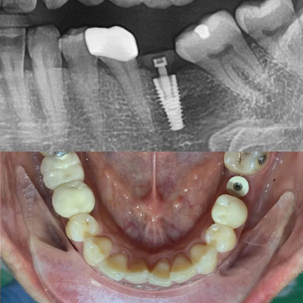 Trước điều trị