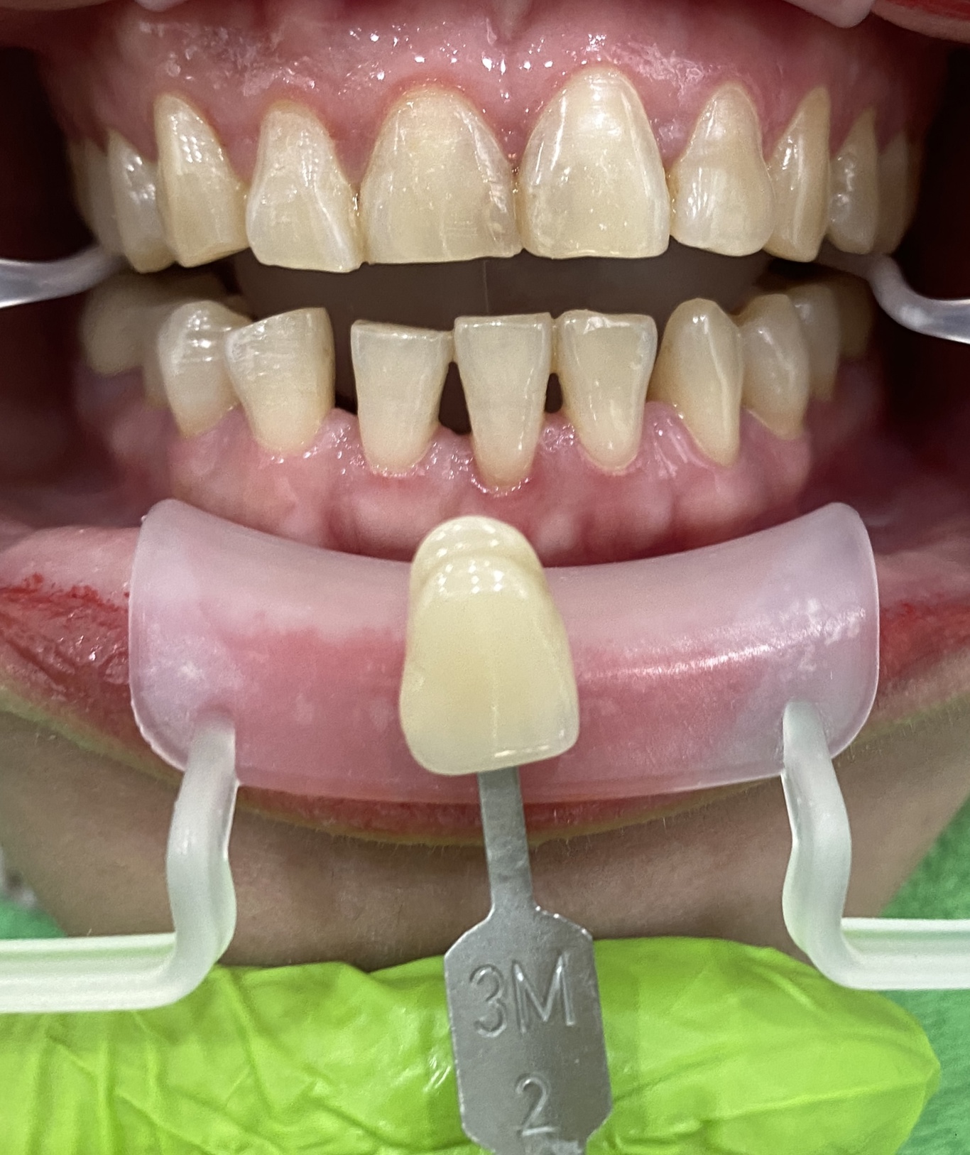 Trước điều trị
