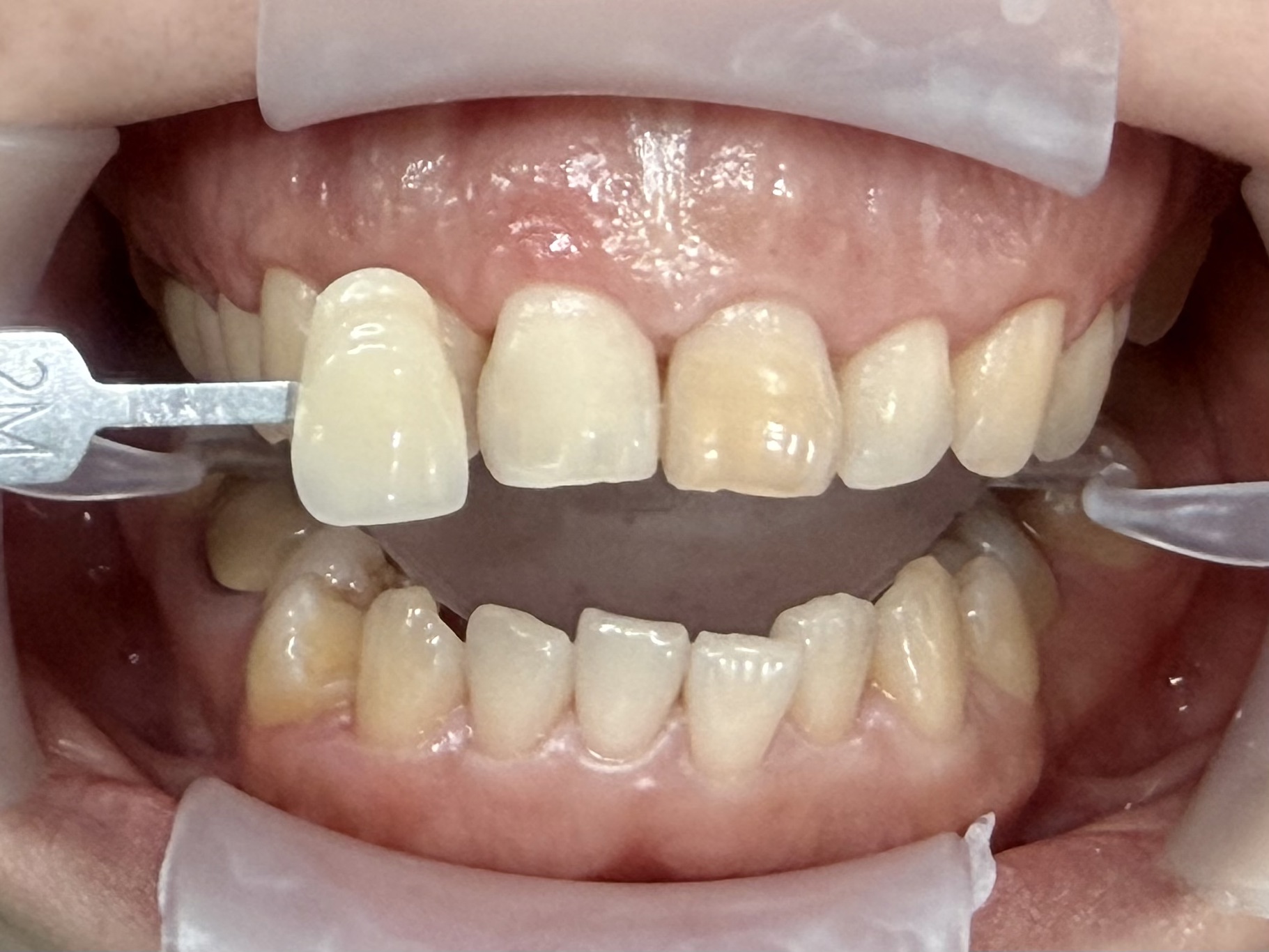 Trước điều trị