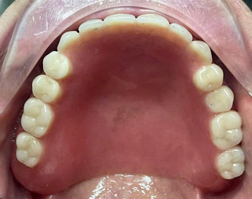 Sau điều trị