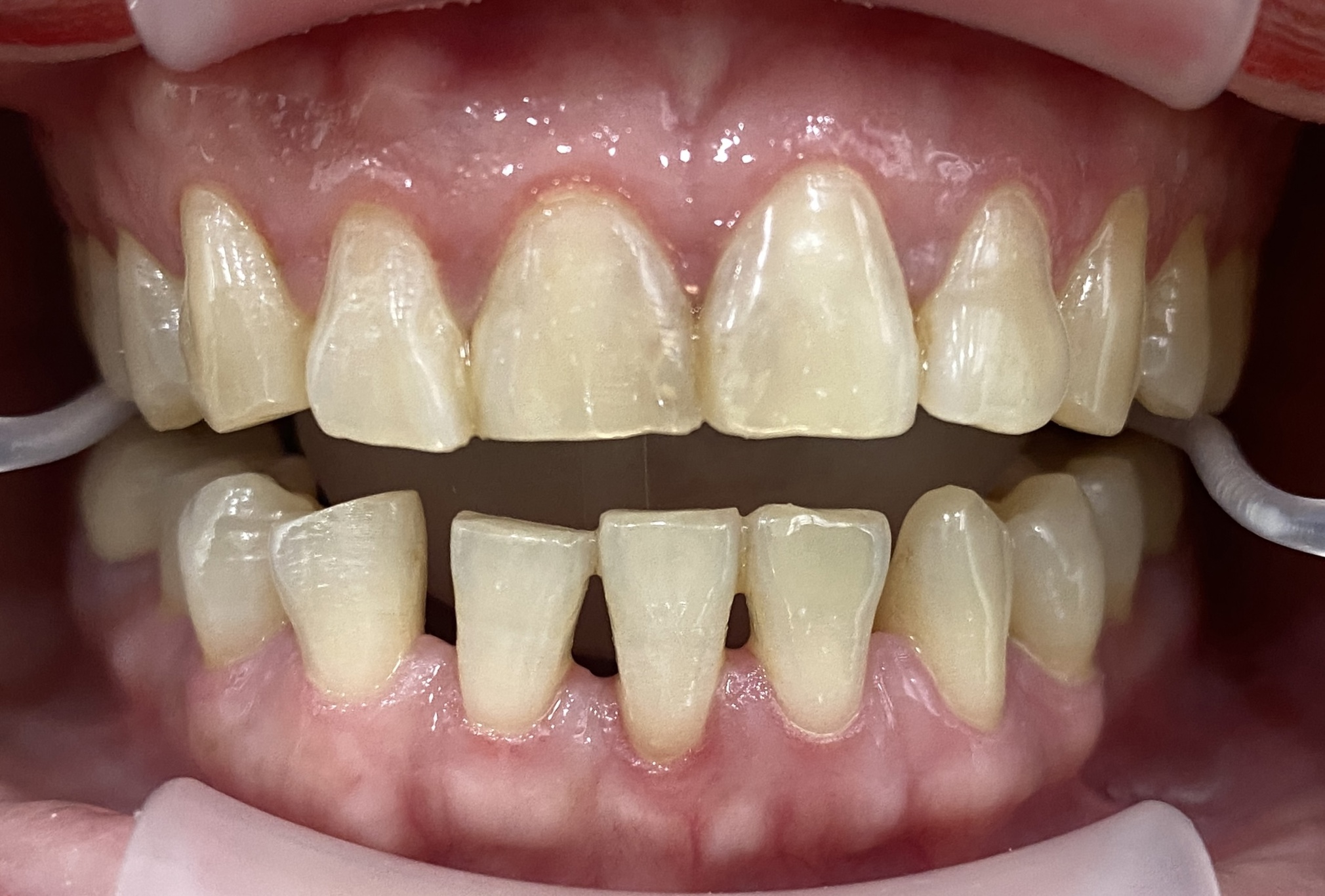Trước điều trị