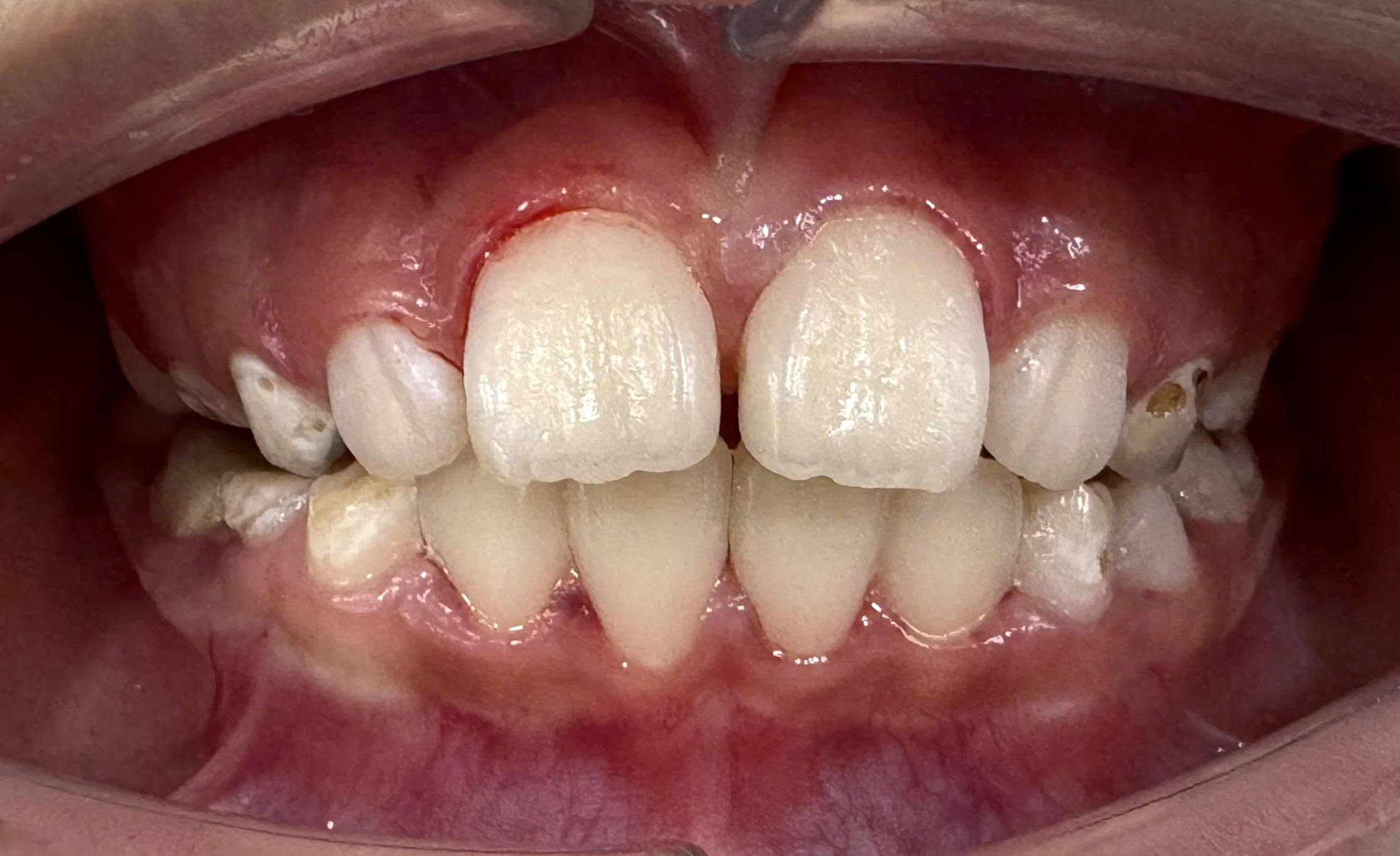 Trước điều trị