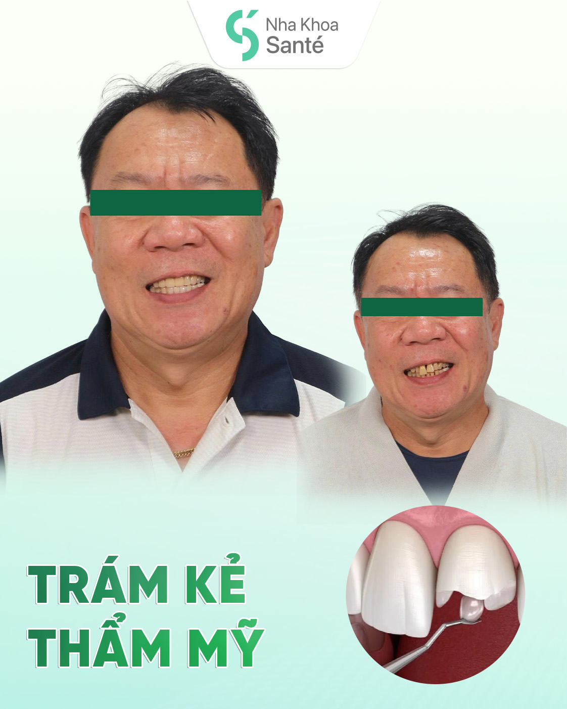 Premium porcelain crowns (Cercon)