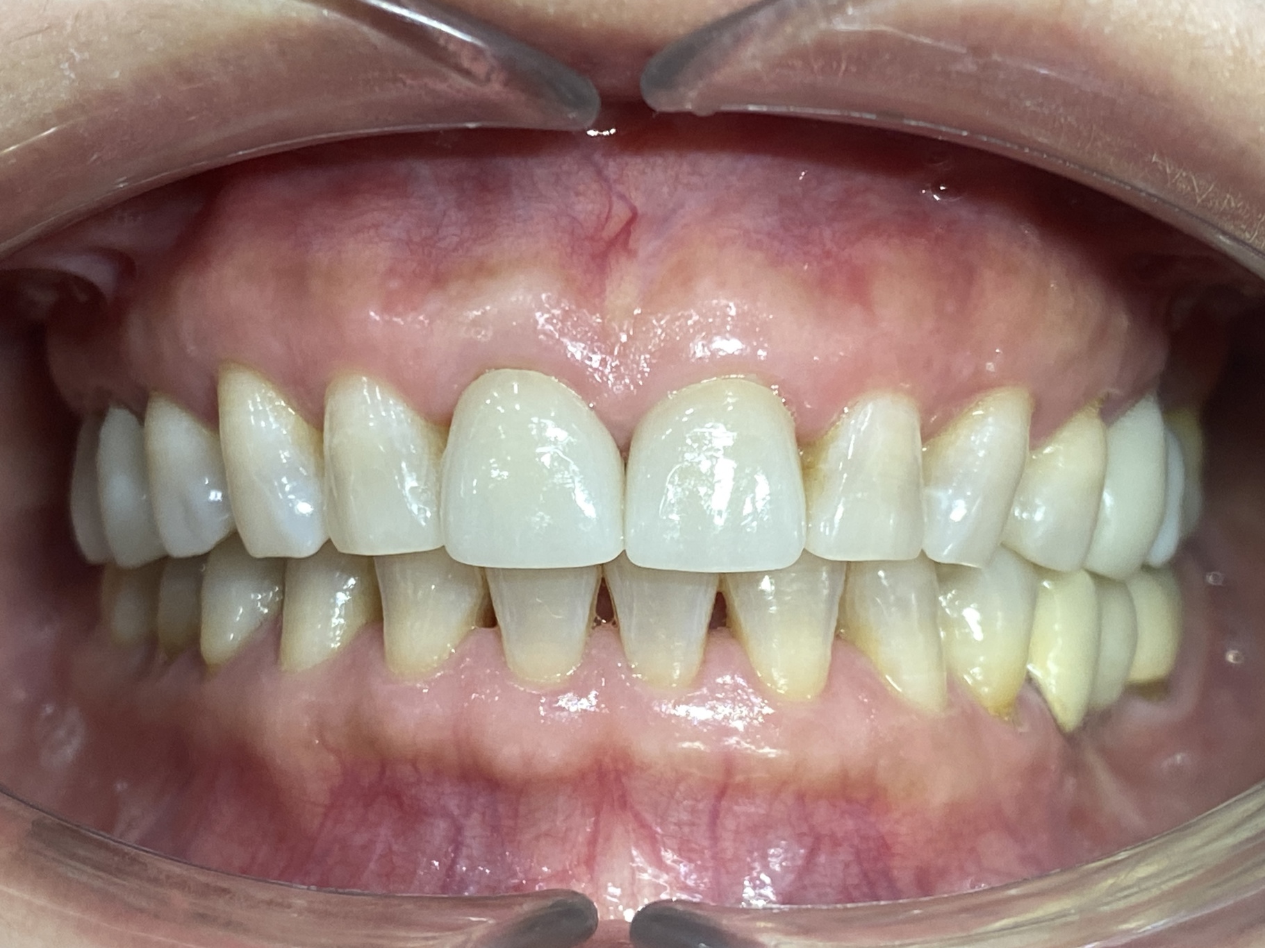Trước điều trị
