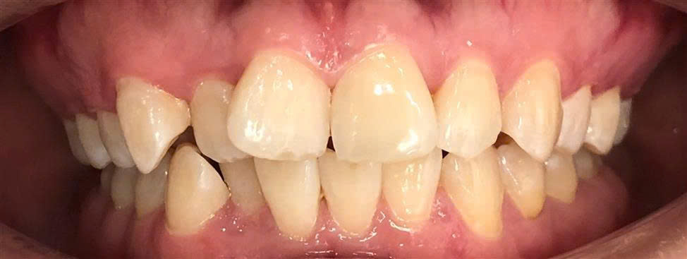 Trước điều trị