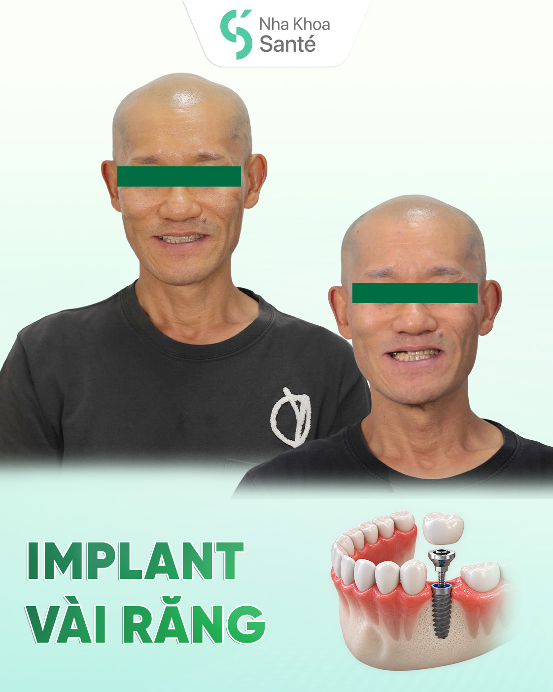 Full Porcelain Crown Smile Makeover