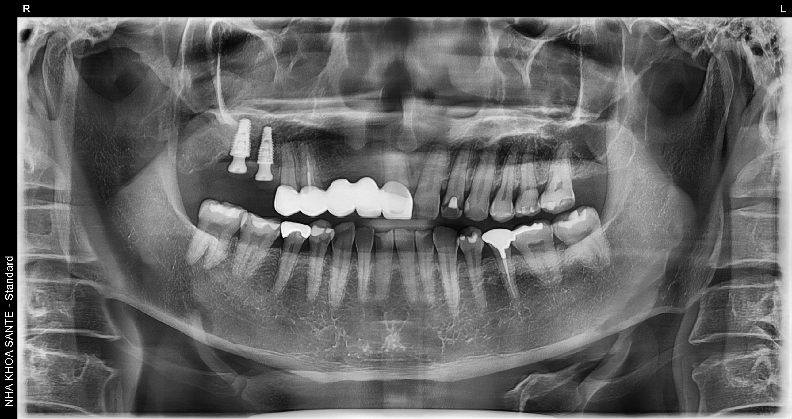 Full Porcelain Crown Smile Makeover