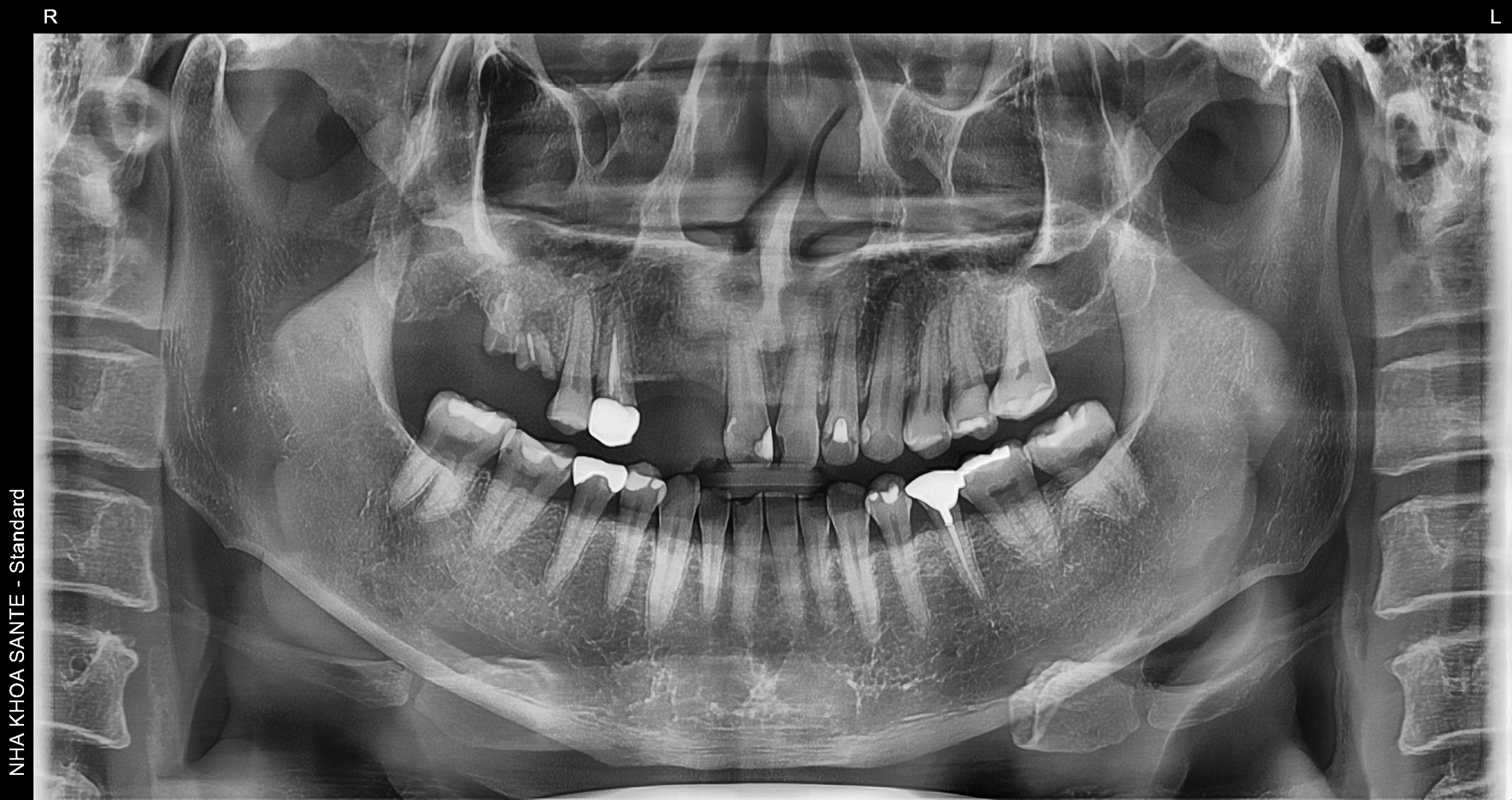 Full Porcelain Crown Smile Makeover