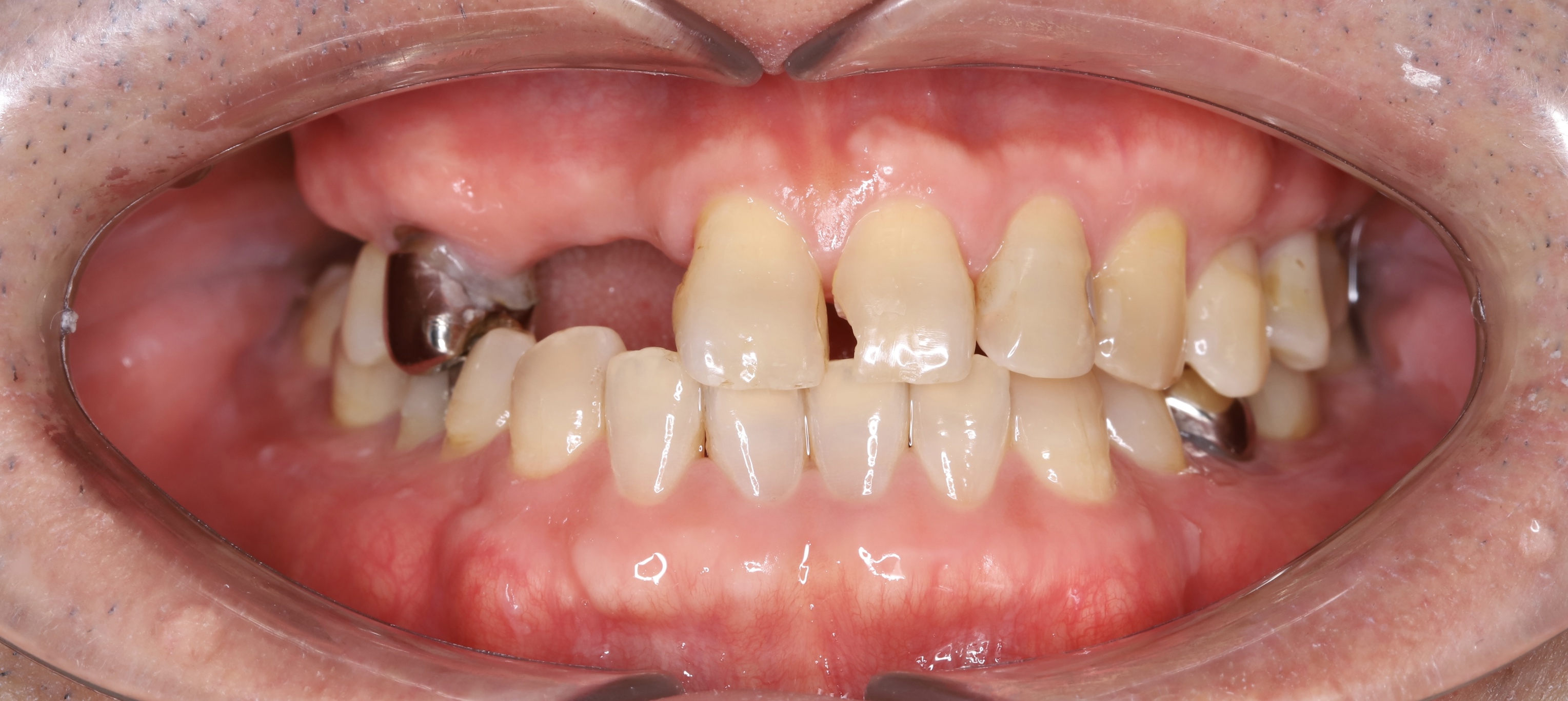 Full Porcelain Crown Smile Makeover