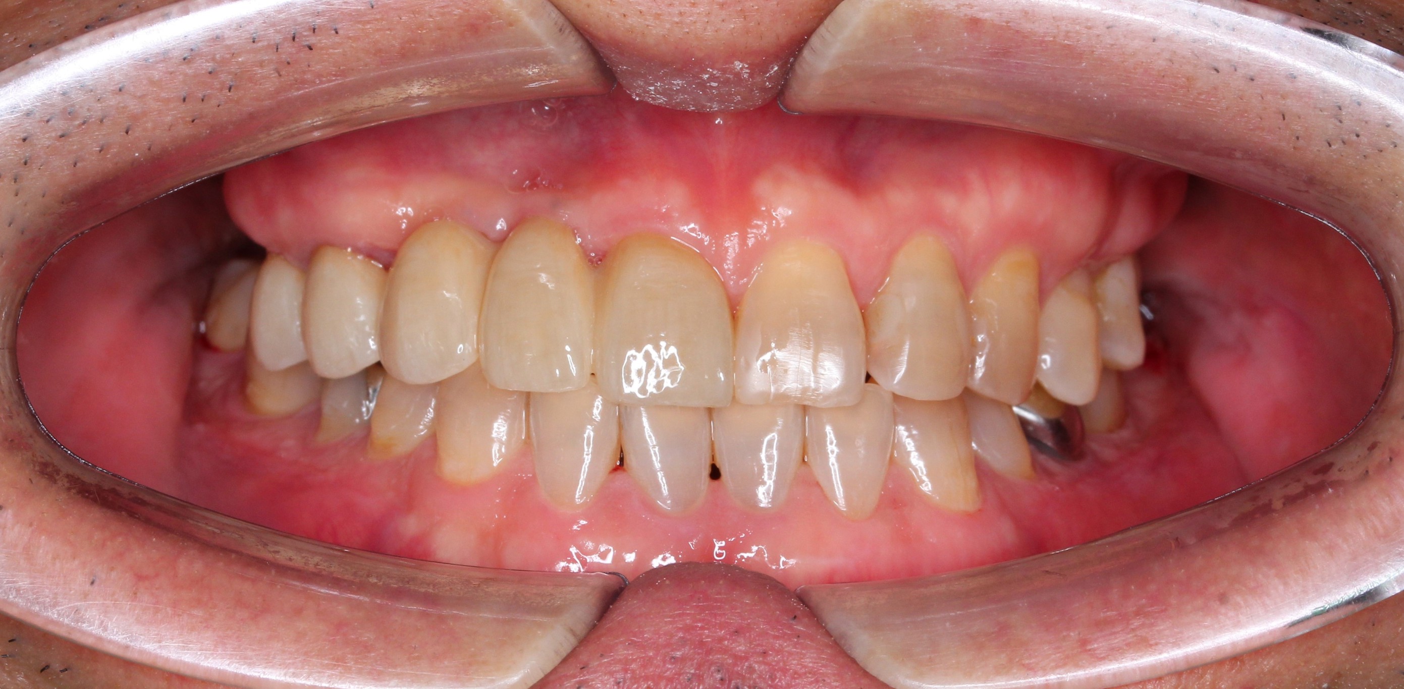 Sau điều trị — Full Porcelain Crown Smile Makeover