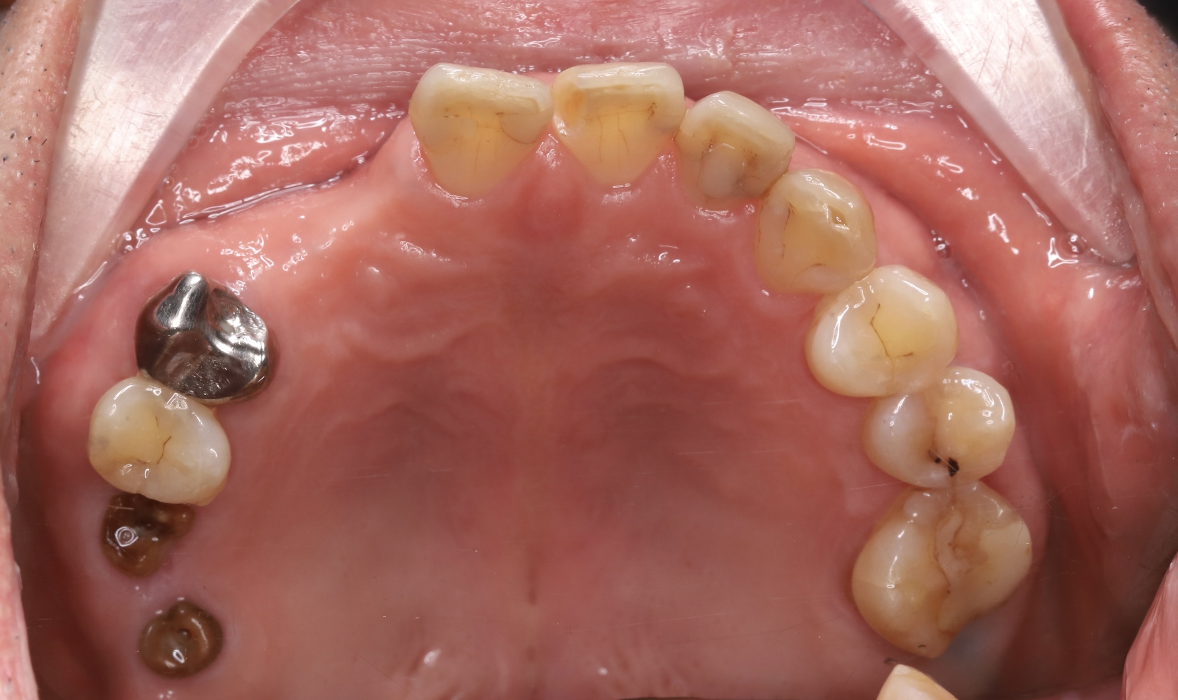 Full Porcelain Crown Smile Makeover