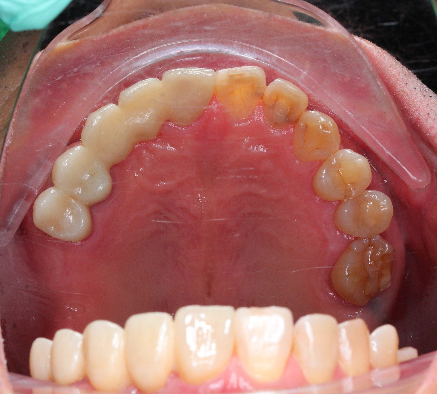 Full Porcelain Crown Smile Makeover