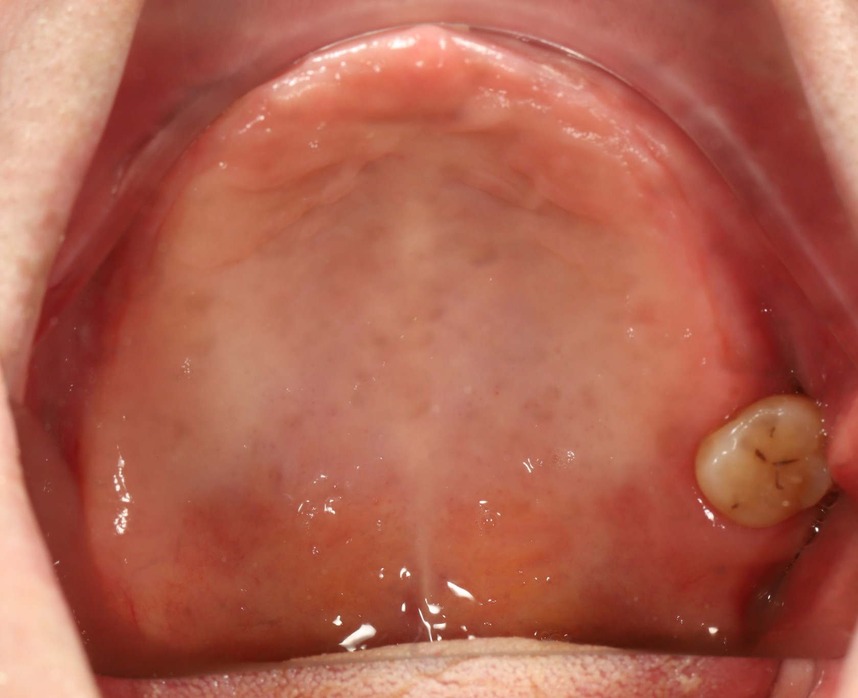 Removable Dentures