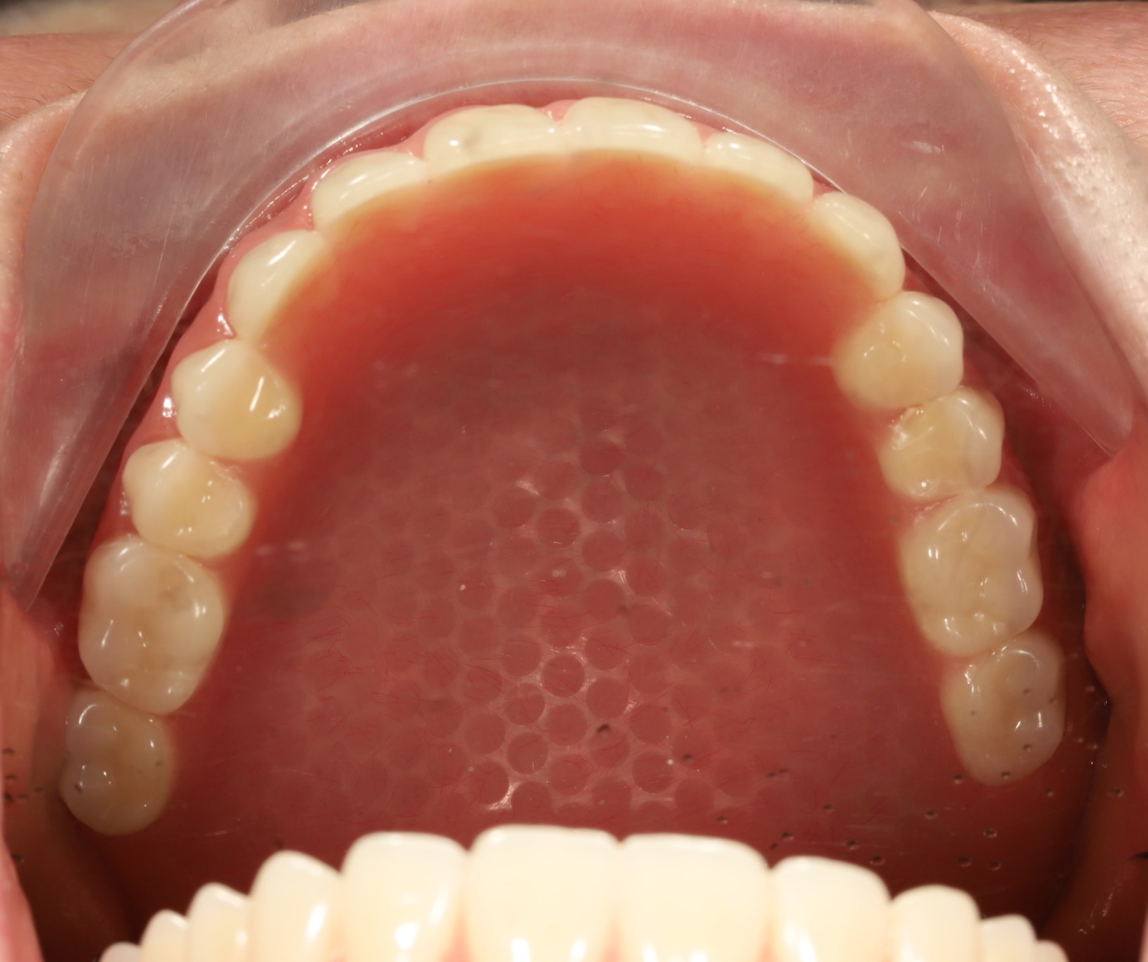 Removable Dentures
