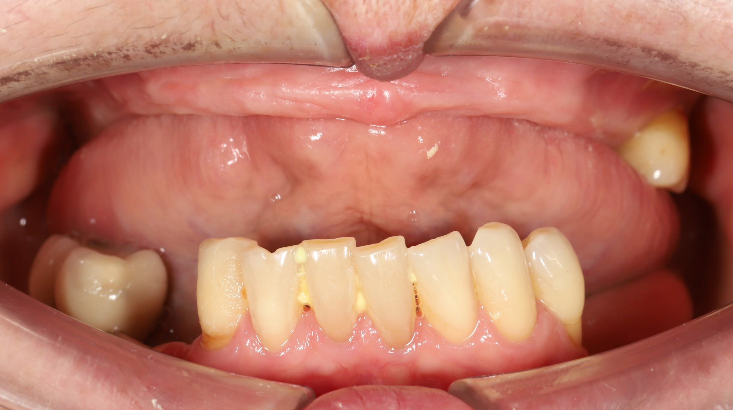 Removable Dentures