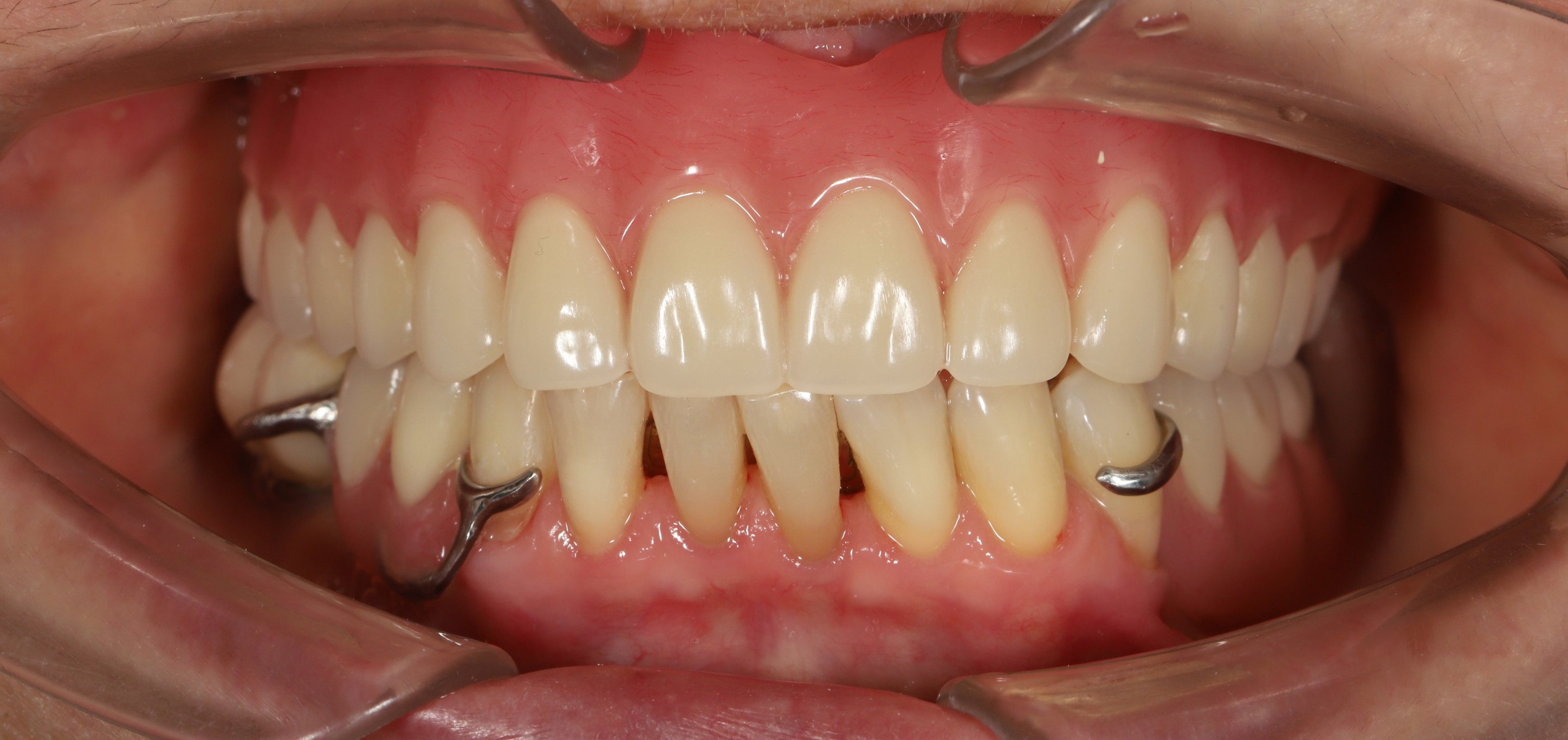 Kết quả điều trị — Removable Dentures