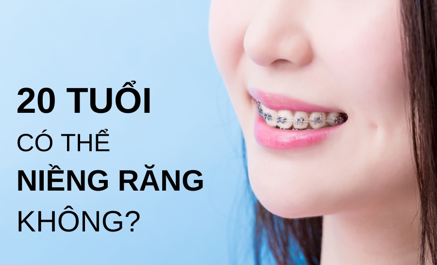 20 Tuổi Niềng Răng Bao Nhiêu Tiền? Thời Gian Niềng Bao Lâu?