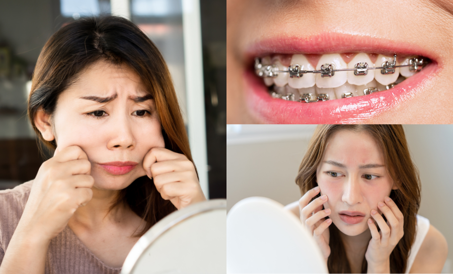 Niềng Răng Có Bị Hóp Má Không? Sự Thật & Tư Vấn Từ Chuyên Gia