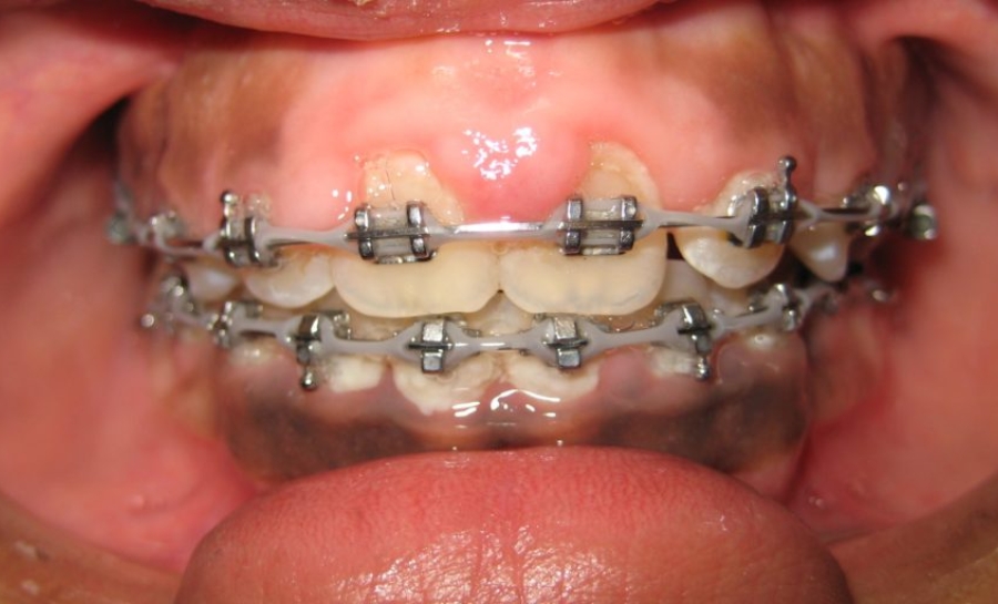 Niềng Răng Bị Tụt Lợi – Nguyên Nhân Và Cách Khắc Phục