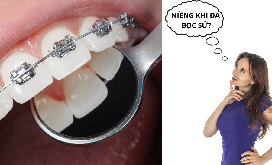Răng Sứ Có Niềng Được Không? Câu Trả Lời Chính Xác Từ Nha Sĩ