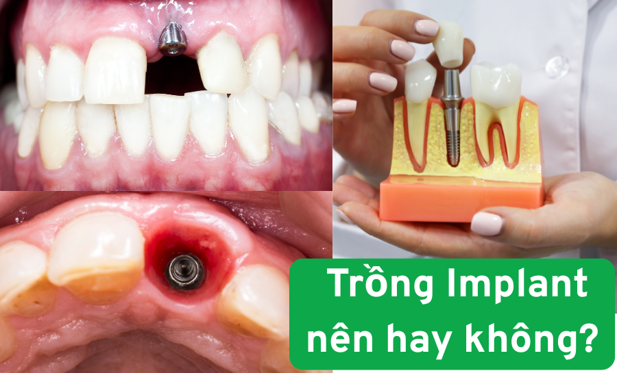 Có Nên Trồng Implant Không? Quy Trình, Thời Gian Và Tư Vấn Từ Bác Sĩ