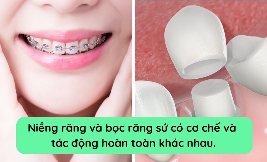 Nên Niềng Răng Hay Bọc Răng Sứ? Minh Hoạ Cụ Thể