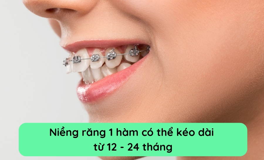 Niềng Răng 1 Hàm Mất Bao Lâu? Chi Phí Bao Nhiêu?