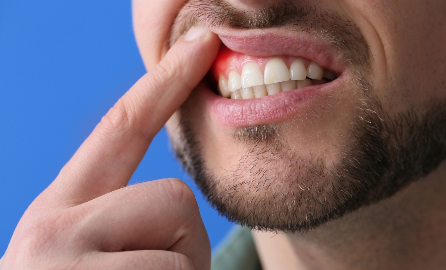 Tác Hại Của Việc Lấy Cao Răng Sai Cách? Có Thể Bạn Chưa Biết
