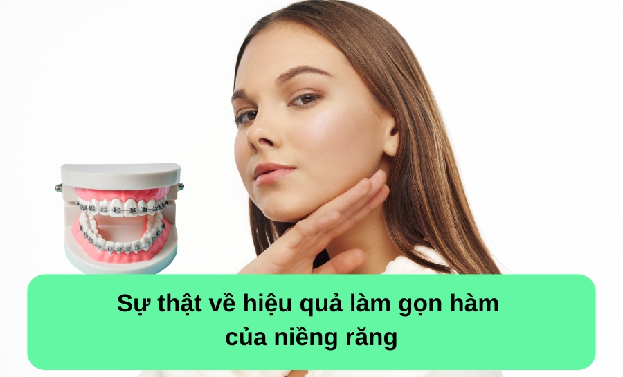 Niềng Răng Có Làm Gọn Hàm Không? Giải Đáp Từ Chuyên Gia Niềng răng có làm gọn hàm không?