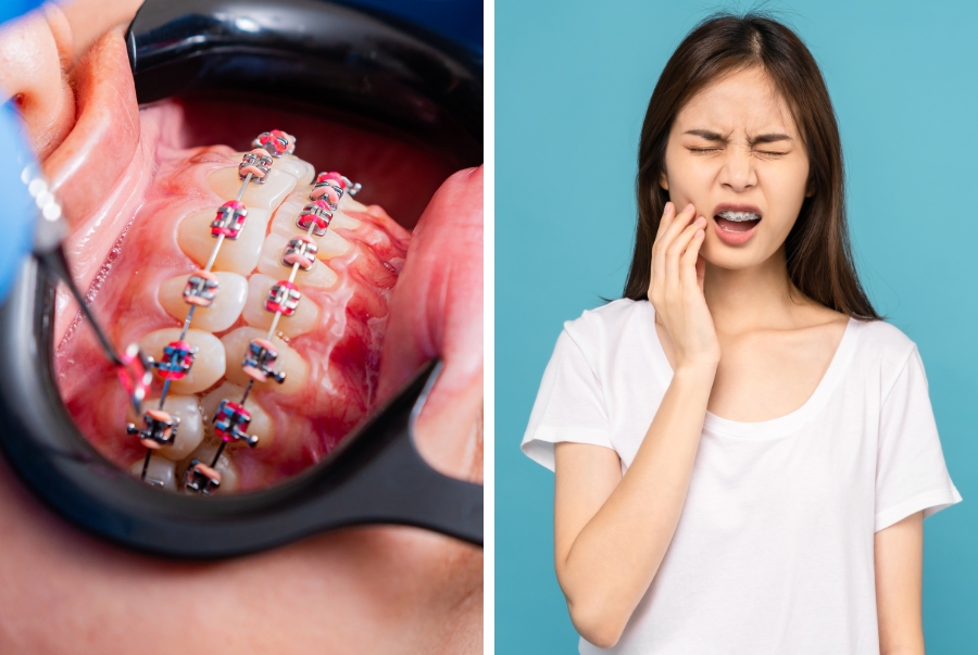 Tại Sao Niềng Răng Bị Sưng Lợi - Cách Điều Trị Và Phòng Ngừa Hiệu Quả
