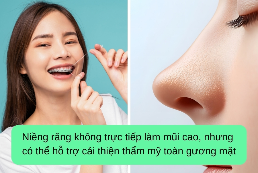 Niềng Răng Có Giúp Mũi Cao Hơn Không? Giải Đáp Cùng Nha Khoa Santé