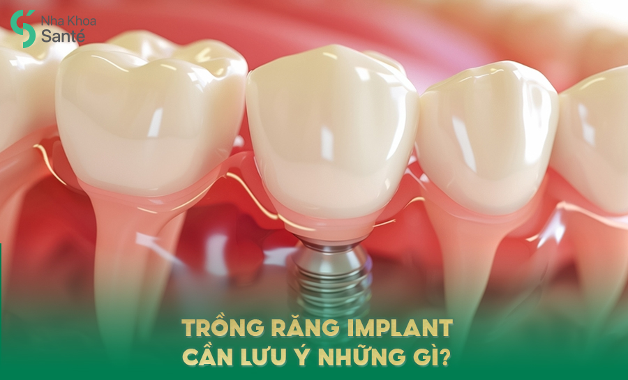 Lưu Ý Khi Trồng Răng Implant – Những Điều Bạn Cần Biết Trước Và Sau Khi Cấy Ghép
