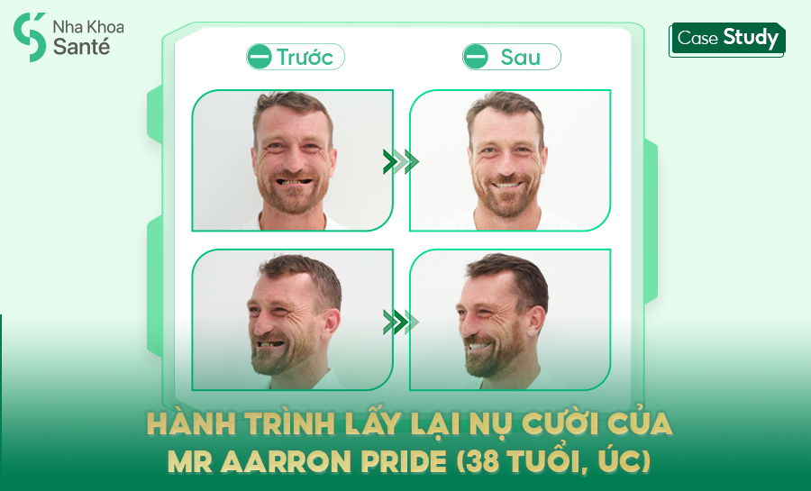 Review Trồng Răng Implant – Hành Trình Lấy Lại Nụ Cười Của Mr Aarron Pride (38 Tuổi, Úc)